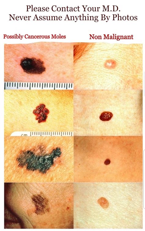 Types of Moles: Noncancerous and Cancerous Pictures